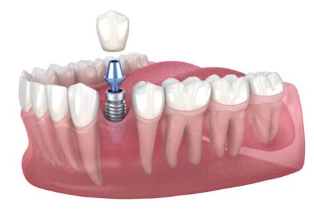 Alonso Smith Centro Odontológico implantes
