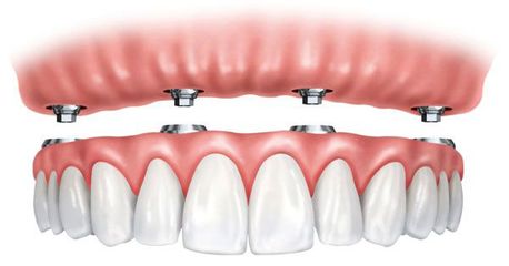 Alonso Smith Centro Odontológico implantes dentales