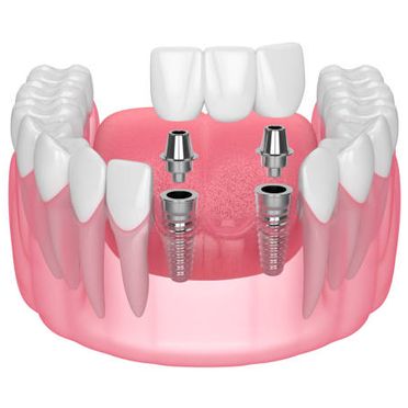 Alonso Smith Centro Odontológico implante en 3d
