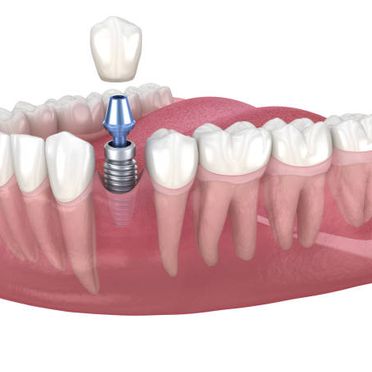Alonso Smith Centro Odontológico diente implante